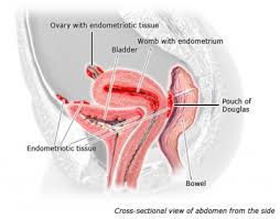 A word that expresses a meaning opposed to the meaning of another word, in which case the two words are antonyms of each other. Endometriosis Causes Symptoms And Treatments