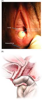 obstetric pelvic floor disorders