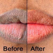 lips with 940 nm diode laser