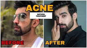 We did not find results for: How To Remove Acne Overnight Natural Pimples Fast Acne Treatment Marks Home Remedies Hindi Youtube