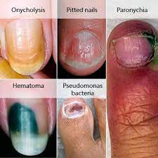 nail disorders wester pharmacy