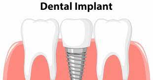 dental implant cost in india types
