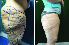 a case of thighs laser liposuction