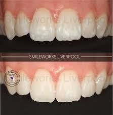 How to prevent white spots on teeth. White Marks On Teeth How To Remove Them Price Review Pictures