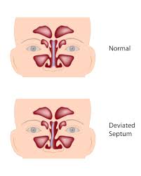 septoplasty otolaryngology