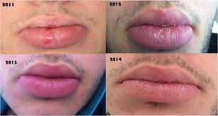 modification of lip swelling the