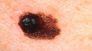 What does melanoma skin cancer look like? Pictures Of Melanoma Skin Changes To Look For And More