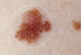 I love to garden, go to the pool, take the kids to the park and oh how i love the beach. Skin Cancer Symptoms Types Images