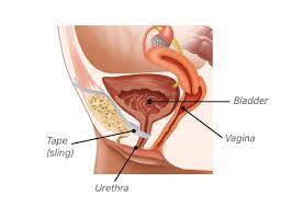 bladder sling complications pain