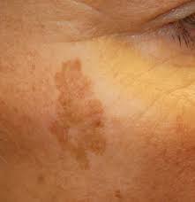 age spots causes symptoms and treatment