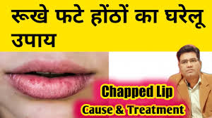 what is chapped lips its cause