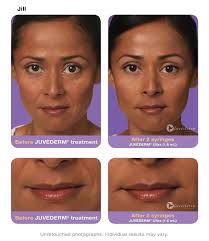 juvederm hermosa beach ca pier