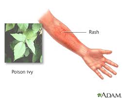poison ivy oak sumac rash