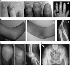 nail patella syndrome clinical and