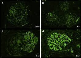 glomerular basement membrane disease
