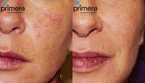 pulsed dye laser skin treatments for