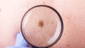 This nonmelanoma skin cancer may appear as a firm red nodule, a scaly growth that bleeds or develops a crust, or a sore that doesn't heal. Woman 24 Recovering From Skin Cancer That Looked Like A Pimple