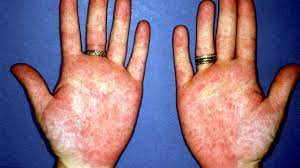 Authoritative facts from dermnet new zealand. Palmar Erythema Symptoms Causes Treatment And More