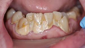 Parodontitis | Tandartspraktijk Godent | Someren