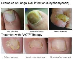 what is pact fungal nail therapy we