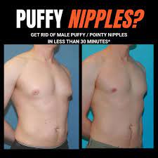 Puffy Nipples Before & After Photos | XSculpt™