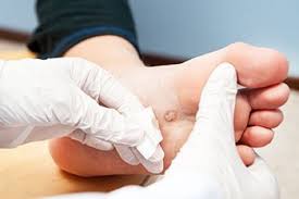 when should i see a doctor for foot warts
