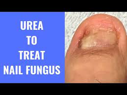 use urea to treat nail fungus you