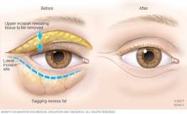 Image result for icd 10 code for ptosis right upper eyelid