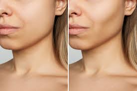 all about cheek buccal fat removal