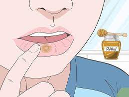 treat mouth ulcers naturally