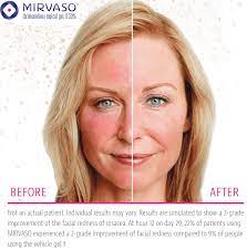 get real redness relief for rosacea