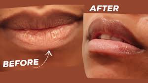 dry chapped ling lips remedy in