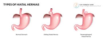 hiatal hernia g l surgical clinic