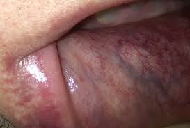 painful vein blood vessels on lip