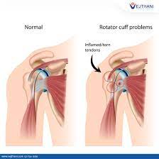 effective treatment for rotator cuff