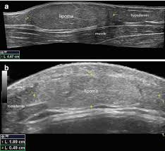 ultrasound application in dermatologic