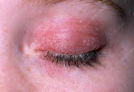 eczema on eyelid stock image m150