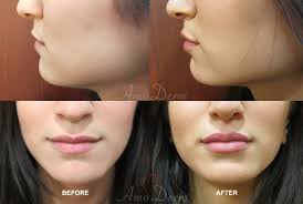 lip injections lip fillers