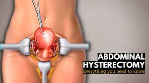 abdominal hysterectomy everything you