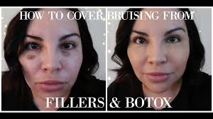 cover bruising from fillers botox