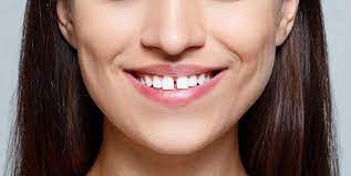 Too short teeth, which look unaesthetic. How To Fix Gap In Front Teeth Without Braces