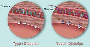 type 1 diabetes vs type 2 diabetes 14