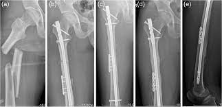 segmental fem fractures