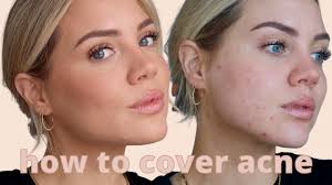 how to cover acne redness scarring