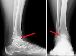 ankle replacement surgery how it works