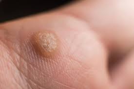 treatment options for plantar warts