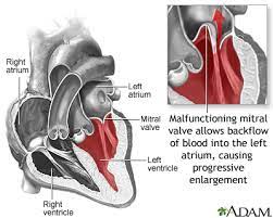 The flaps of the valve are floppy and may not close tightly. Mitral Valve Prolapse Medlineplus Medical Encyclopedia