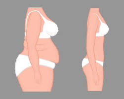 what is the best surgery to lose weight