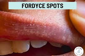fordyce spots identification causes