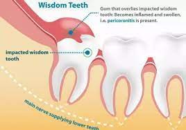 Why Does My Wisdom Tooth Not Hurt gambar png